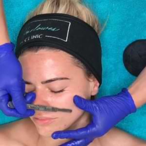 dermaplanning treatment